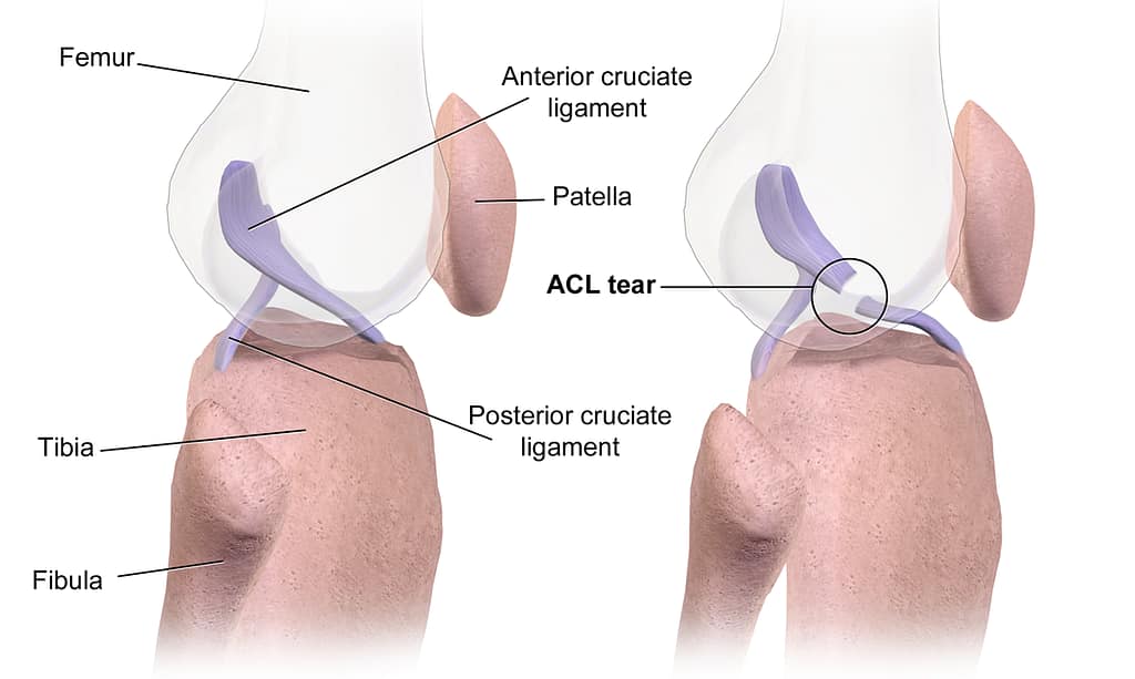 How to Prevent ACL Injury
