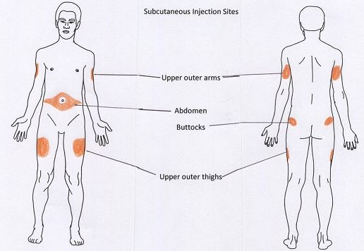 SubQ HCG injection sites