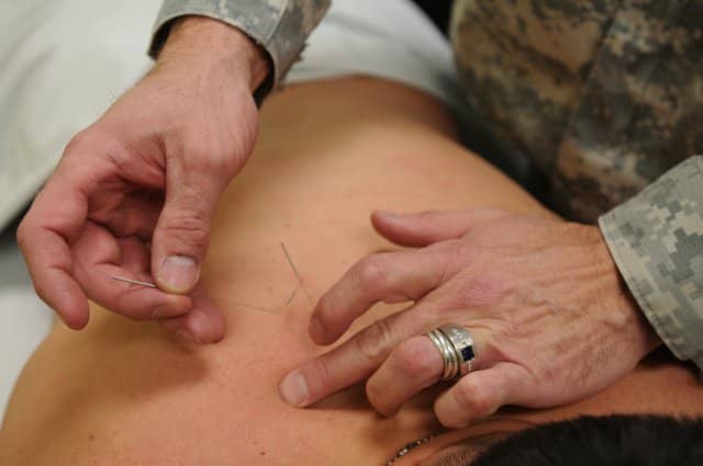 Acupuncture for Pain Releif
